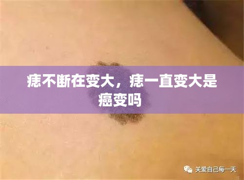 痣不断在变大,痣一直变大是癌变吗
